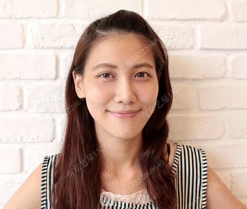 Yestar美杜莎美眼術一周案例圖片，芭比雙眼皮果很好~