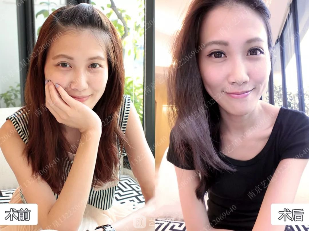 Yestar美杜莎美眼術一周案例圖片，芭比雙眼皮果很好~