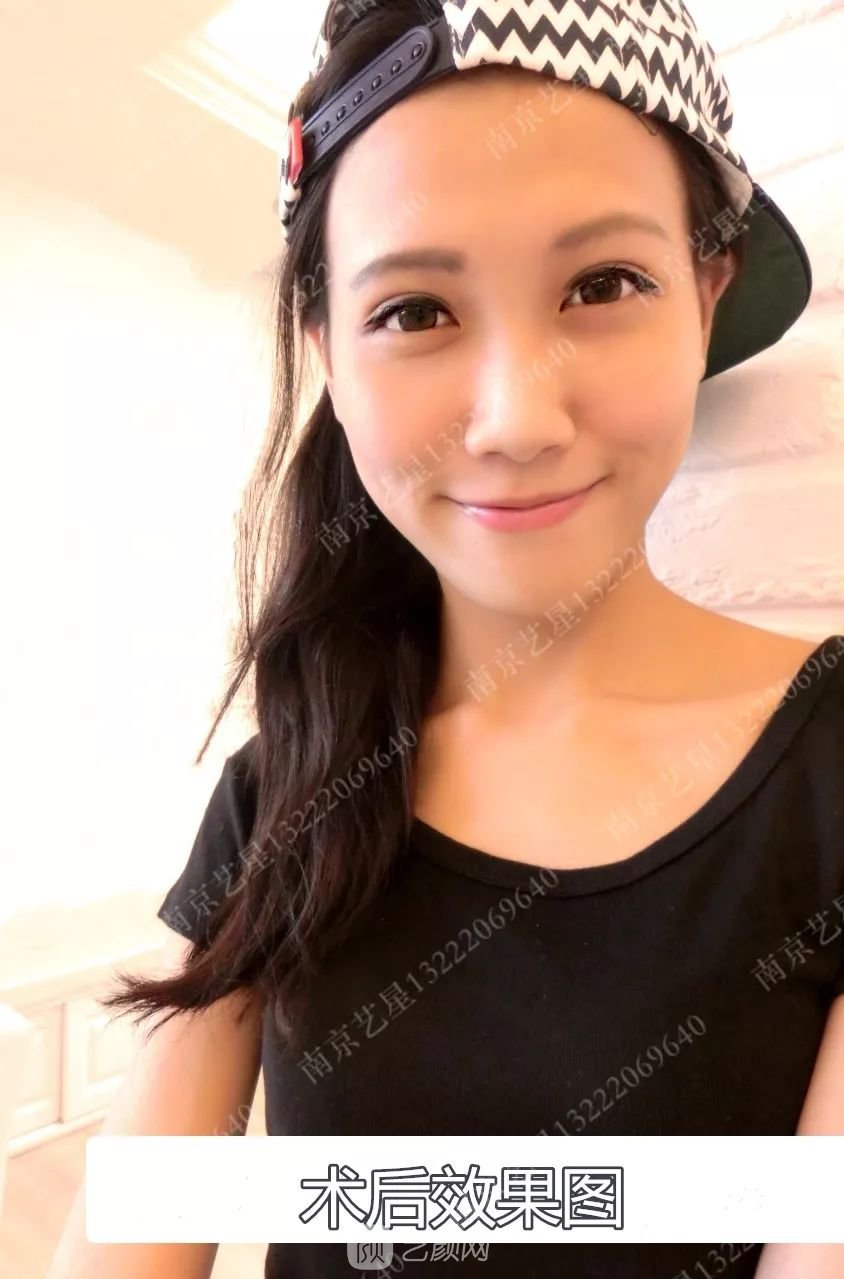 Yestar美杜莎美眼術一周案例圖片，芭比雙眼皮果很好~