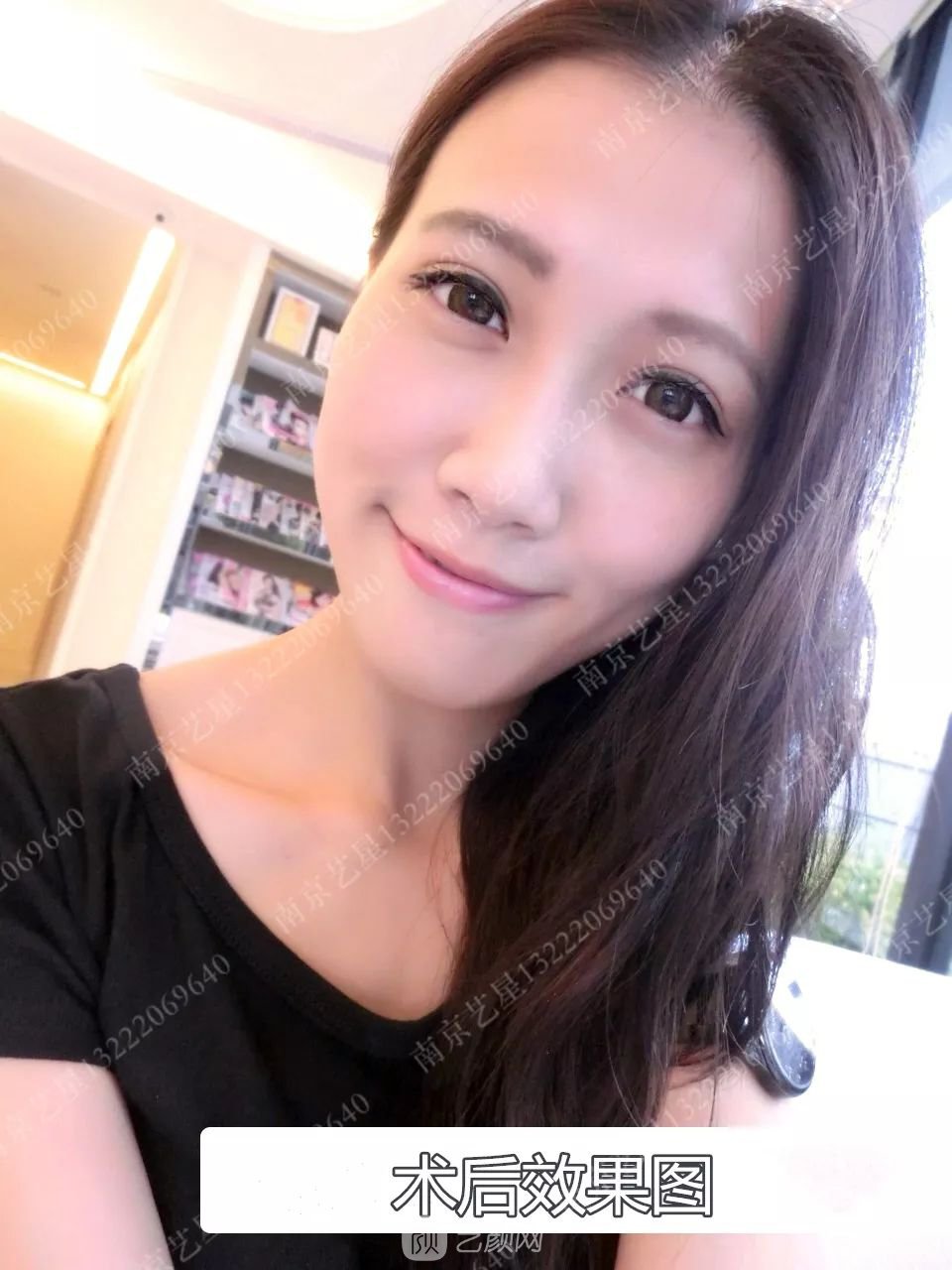 Yestar美杜莎美眼術一周案例圖片，芭比雙眼皮果很好~