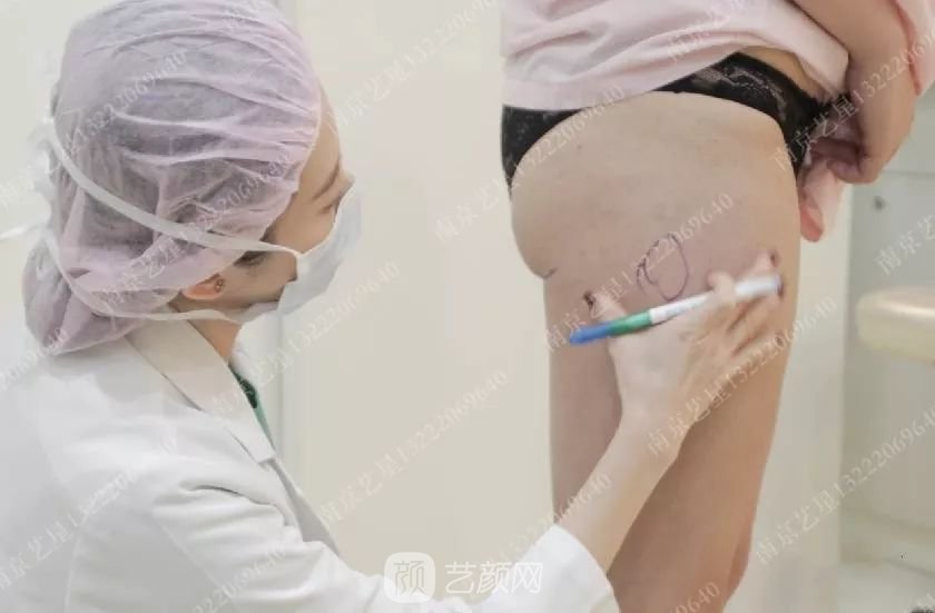 南京藝星自體脂肪豐胸術(shù)一個月案例分享~