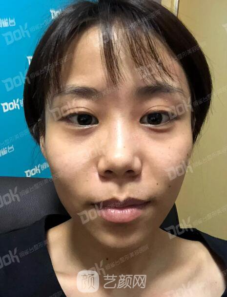 內(nèi)切祛眼袋果怎么樣？來瞧瞧這些照片就可能會有答案了哦~