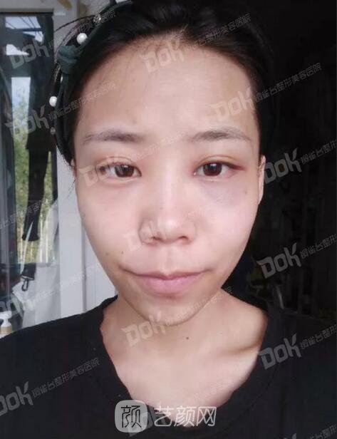 內(nèi)切祛眼袋果怎么樣？來瞧瞧這些照片就可能會有答案了哦~