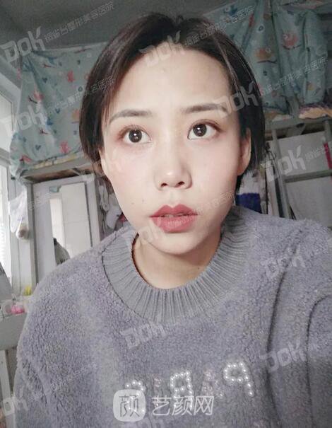 內(nèi)切祛眼袋果怎么樣？來瞧瞧這些照片就可能會有答案了哦~