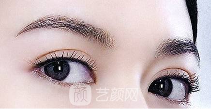 雙眼皮兩個(gè)月，是這個(gè)樣子的，大家來(lái)看看
