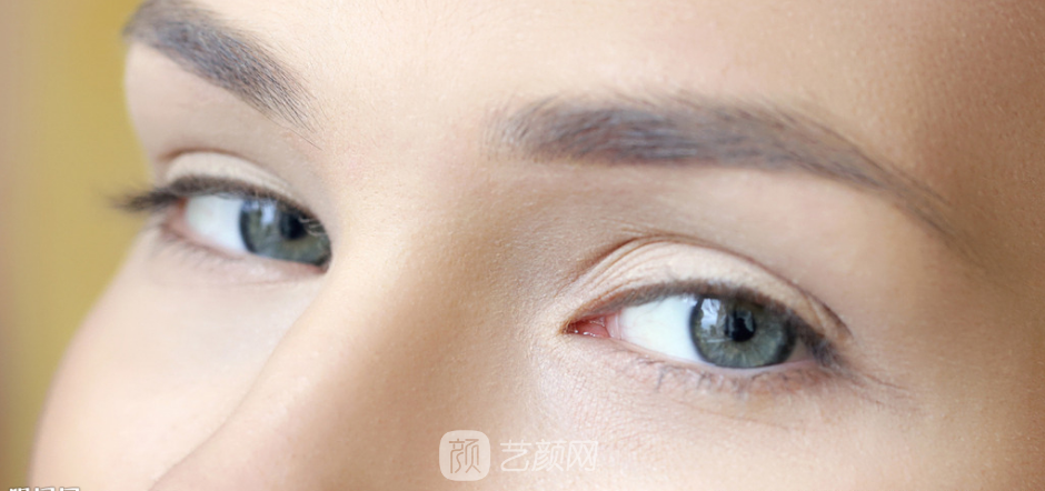 雙眼皮手術(shù)類型太多，怎么選擇?