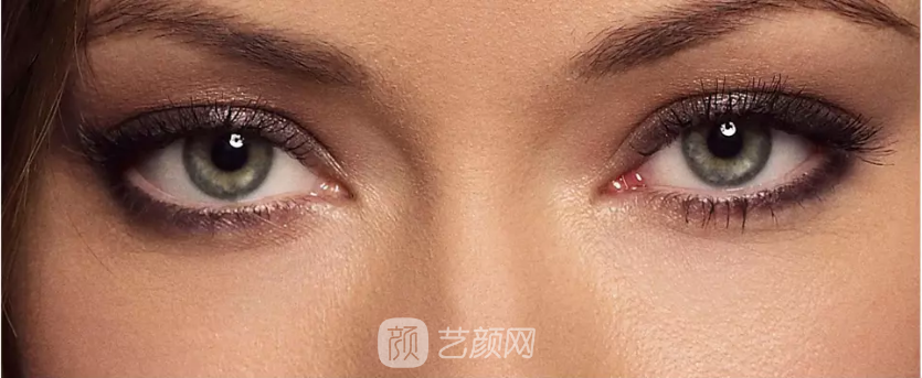 雙眼皮手術(shù)類型太多，怎么選擇?