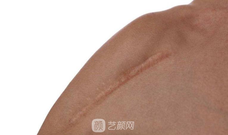 杭州激光去疤費用，多久見