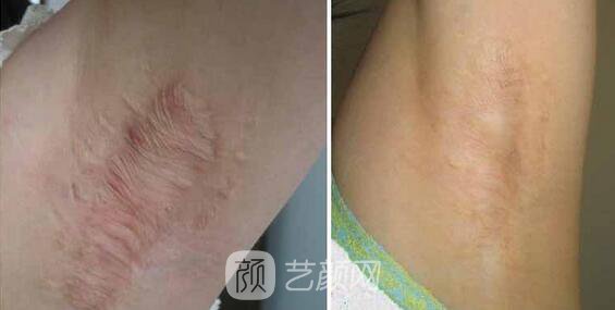 杭州激光去疤費用，多久見