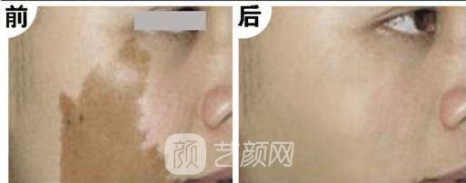 湖南激光祛斑好嗎？
