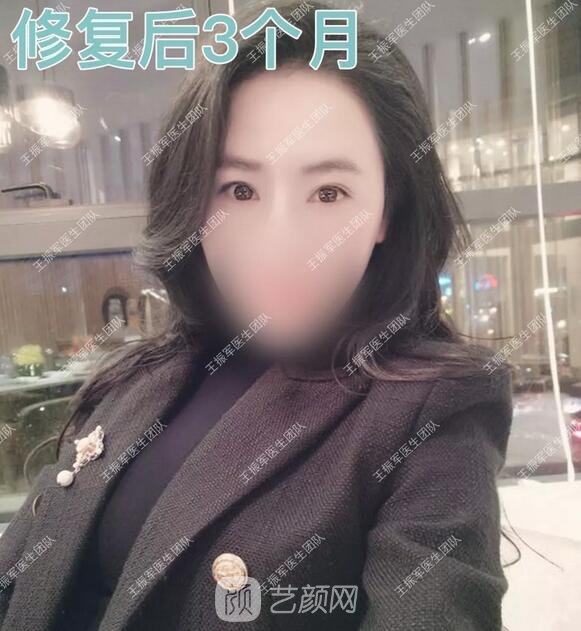 雙眼皮修復(fù)后3個(gè)月