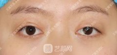上瞼下垂的小伙伴想沒想過你也可以這樣做！