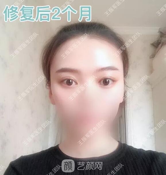 雙眼皮修復(fù)術(shù)后兩個(gè)月果