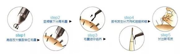 頭發(fā)種植
