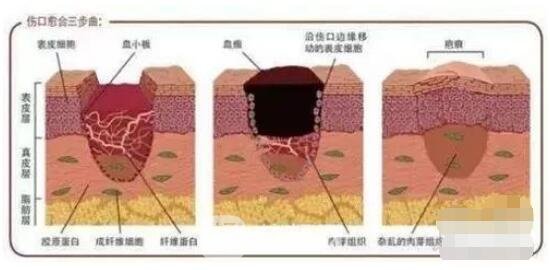 疤痕產(chǎn)生流程