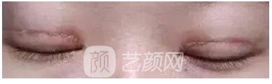 創(chuàng)口疤痕顯著