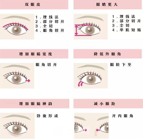 常見的雙眼皮形態(tài)