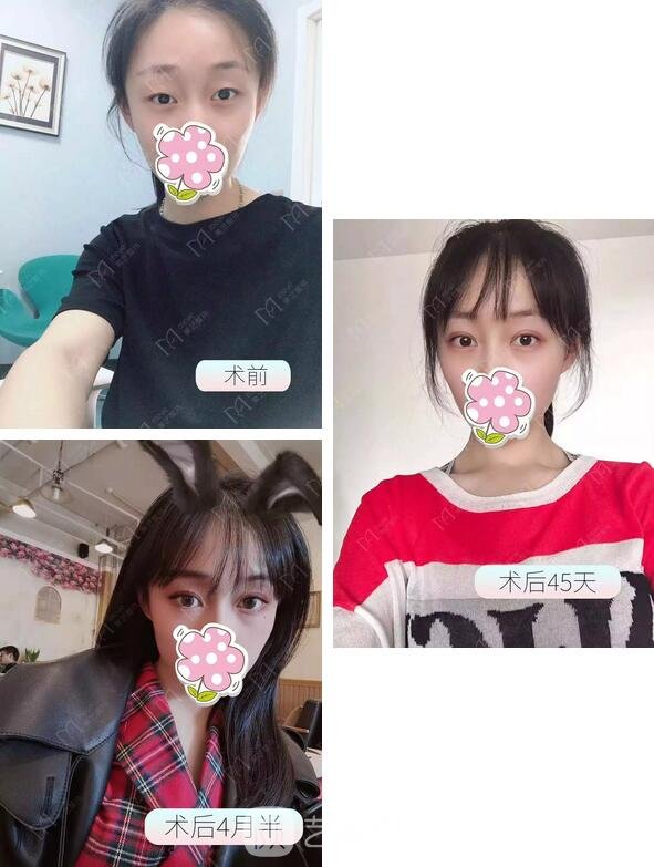 全切雙眼皮+眶隔人體脂肪釋放+開(kāi)內(nèi)眼角