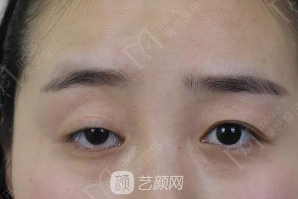 上瞼下垂如果不重視雙眼皮做了也白做！