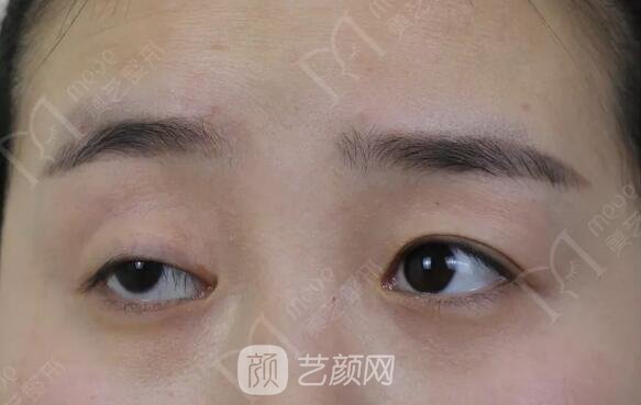 上瞼下垂如果不重視雙眼皮做了也白做！