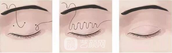 埋線雙眼皮