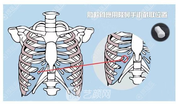 取肋軟骨材料位置示意圖