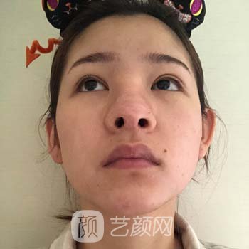 上海美萊整形醫(yī)院做鼻子案例