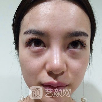 廣州曙光醫(yī)療美容醫(yī)院價(jià)目表|去眼袋案例果參考